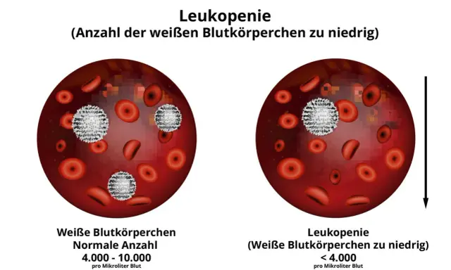 Vergleich von Blutbildern: Links normale Anzahl weißer Blutkörperchen, rechts Leukopenie (weiße Blutkörperchen zu niedrig).
