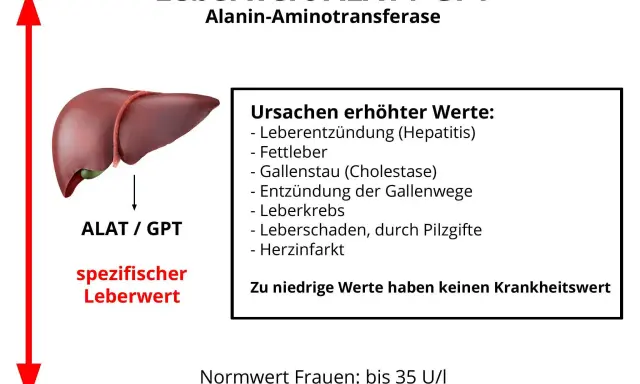 Leberwert ALAT/GPT, ein spezifischer Leberwert, kann bei Hepatitis, Fettleber oder anderen Ursachen erhöht sein. Niedrige Werte sind irrelevant.