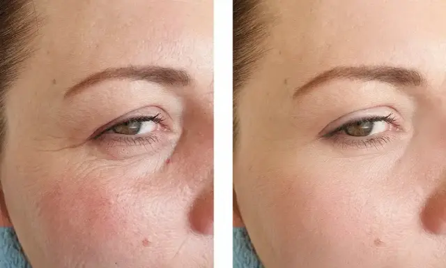 Vorher-Nachher-Vergleich zeigt die beeindruckende **Retinol Wirkung** auf die Haut. Falten sind sichtbar reduziert, die Haut wirkt glatter und jugendlicher.