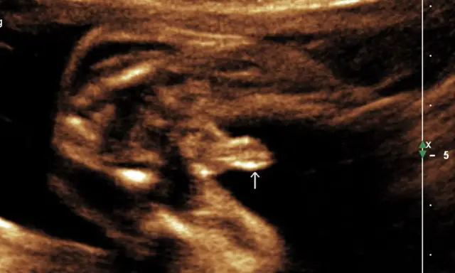 Ultraschallbild eines Babys in der 20. SSW. Der Pfeil zeigt auf die Genitalien, die auf XY-Chromosomen hindeuten.