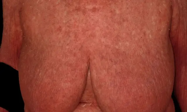 Hautveränderungen, die auf Pityriasis rubra pilaris hindeuten, zeigen sich als rote, schuppende Flecken auf der Brust und den Armen.