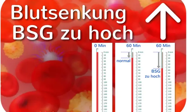 Blutsenkung: BSG zu hoch. Rote Blutkörperchen und Messzylinder zeigen eine erhöhte BSG an, was auf Entzündungen hindeuten kann.
