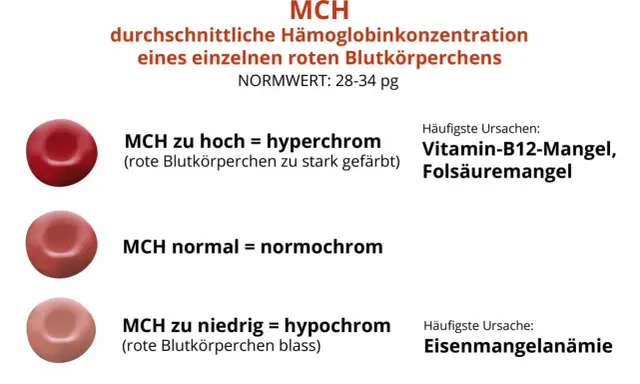 MCH-Wert: rote Blutkörperchen können hyperchrom (zu stark gefärbt), normochrom oder hypochrom (blass) sein. Ursachen für MCH-Abweichungen sind u.a. Vitaminmangel oder Eisenmangelanämie.