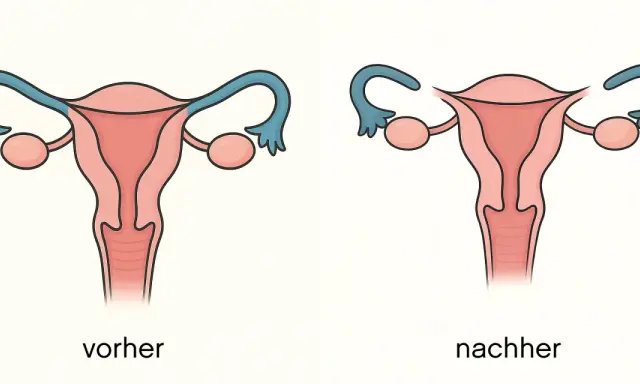 Vergleich: Gebärmutter mit durchgängigen Eileitern (vorher) und nach Sterilisation Frau (nachher), wo die Eileiter unterbrochen sind.
