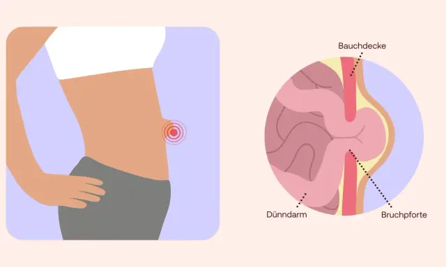 Illustration zeigt einen Bauch mit einem roten Schmerzpunkt und eine Nahaufnahme eines Nabelbruchs, der Dünndarm durch die Bauchdecke drückt. Nabelbruch Symptome.
