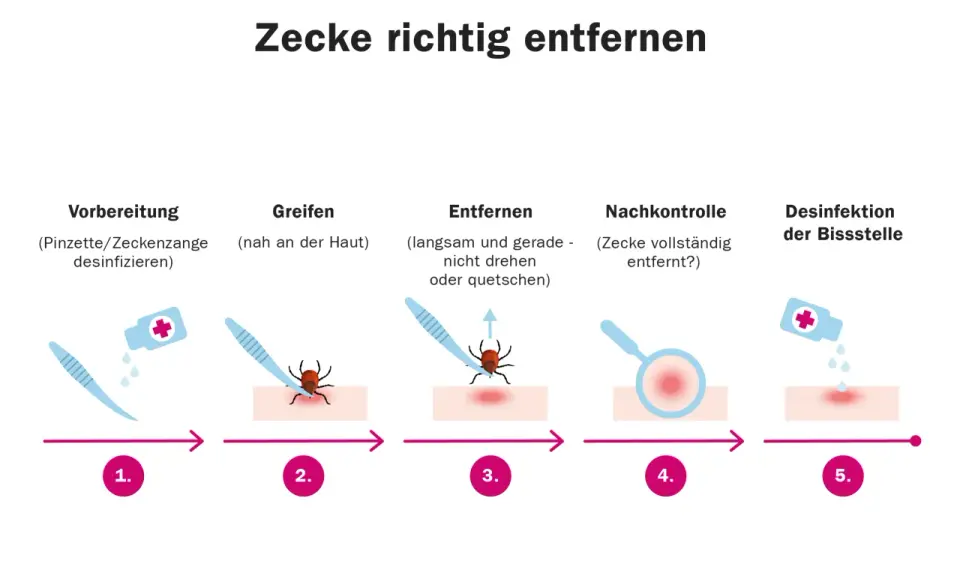 Schritt-für-Schritt-Anleitung zur zecke entfernen: Vorbereitung, Greifen, Entfernen, Nachkontrolle und Desinfektion der Bissstelle.