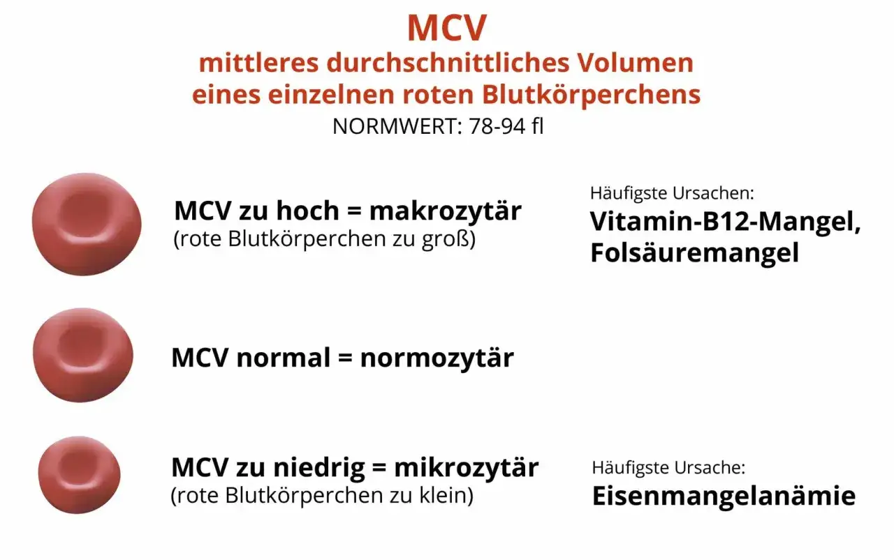 MCV-Wert: Rote Blutkörperchen zu groß (makrozytär) bei Vitamin-B12-/Folsäuremangel. Normal (normozytär). Zu klein (mikrozytär) bei Eisenmangelanämie.