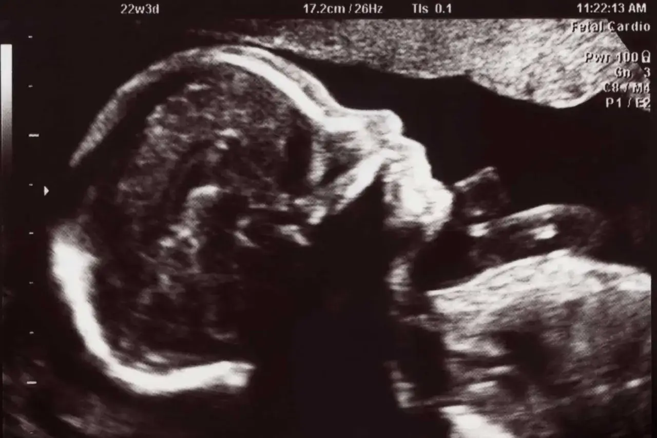 Ultraschallbild eines Babys im Mutterleib, 22 Wochen alt. Ein wichtiger Schritt im 3. Screening der Schwangerschaft.