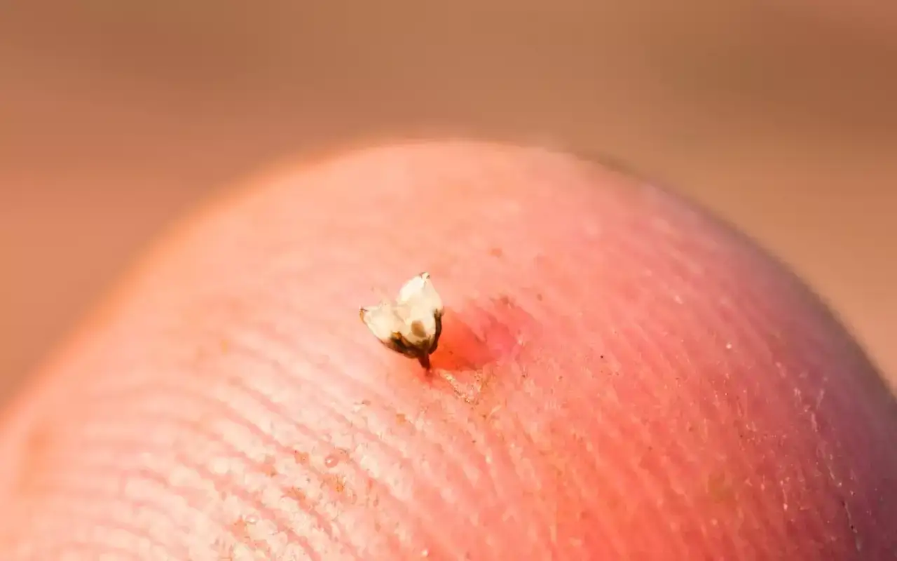 Ein kleiner, weißer Stachel ragt aus einer roten Fingerspitze. Ein Stich! Was tun bei einem Bienestich?