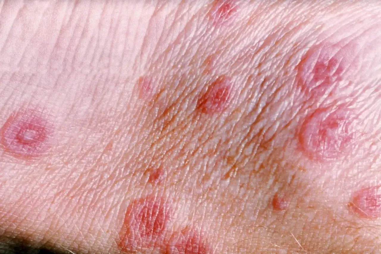 Hautver&auml;nderungen, die auf Erythema exsudativum multiforme hindeuten: rote, ringf&ouml;rmige L&auml;sionen mit zentraler Aufhellung auf der Haut.
