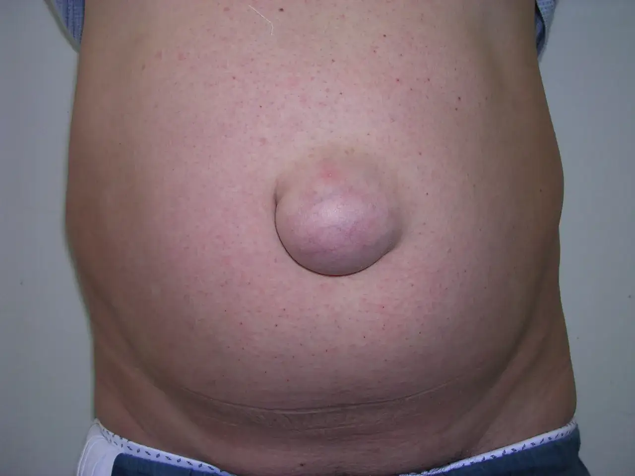 Ein hervorstehender Nabel, ein m&ouml;gliches Zeichen f&uuml;r Nabelbruch Symptome, ist auf dem Bauch sichtbar.