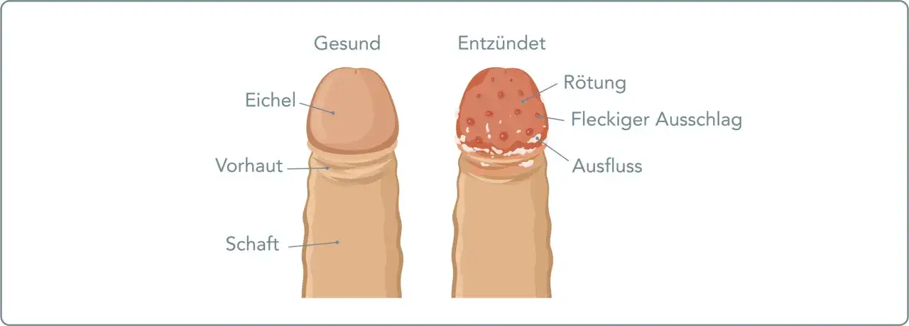Vergleich von gesunder Eichel und entz&uuml;ndeter Eichel mit roten Punkten, R&ouml;tung, fleckigem Ausschlag und Ausfluss.