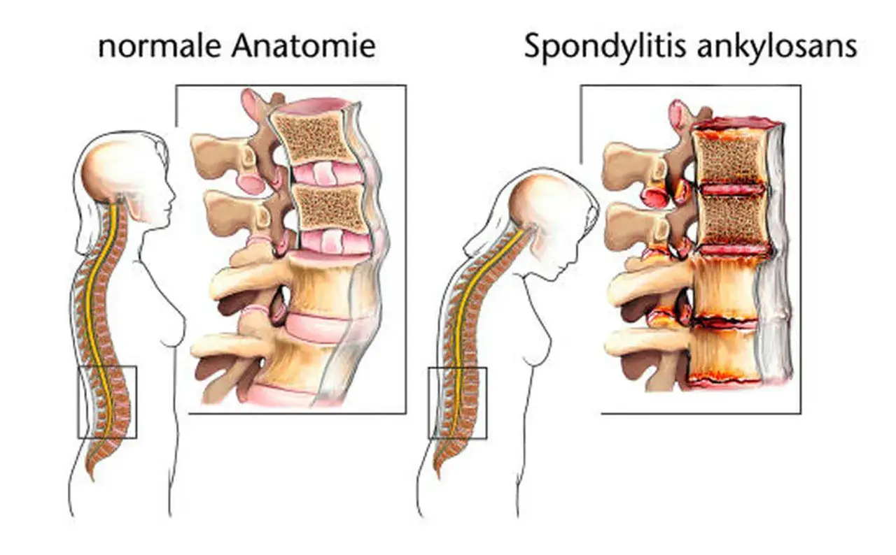 Vergleich: normale Anatomie der Wirbels&auml;ule vs. Morbus Bechterew. Bei Morbus Bechterew versteifen sich die Wirbel und die Haltung wird gebeugt.