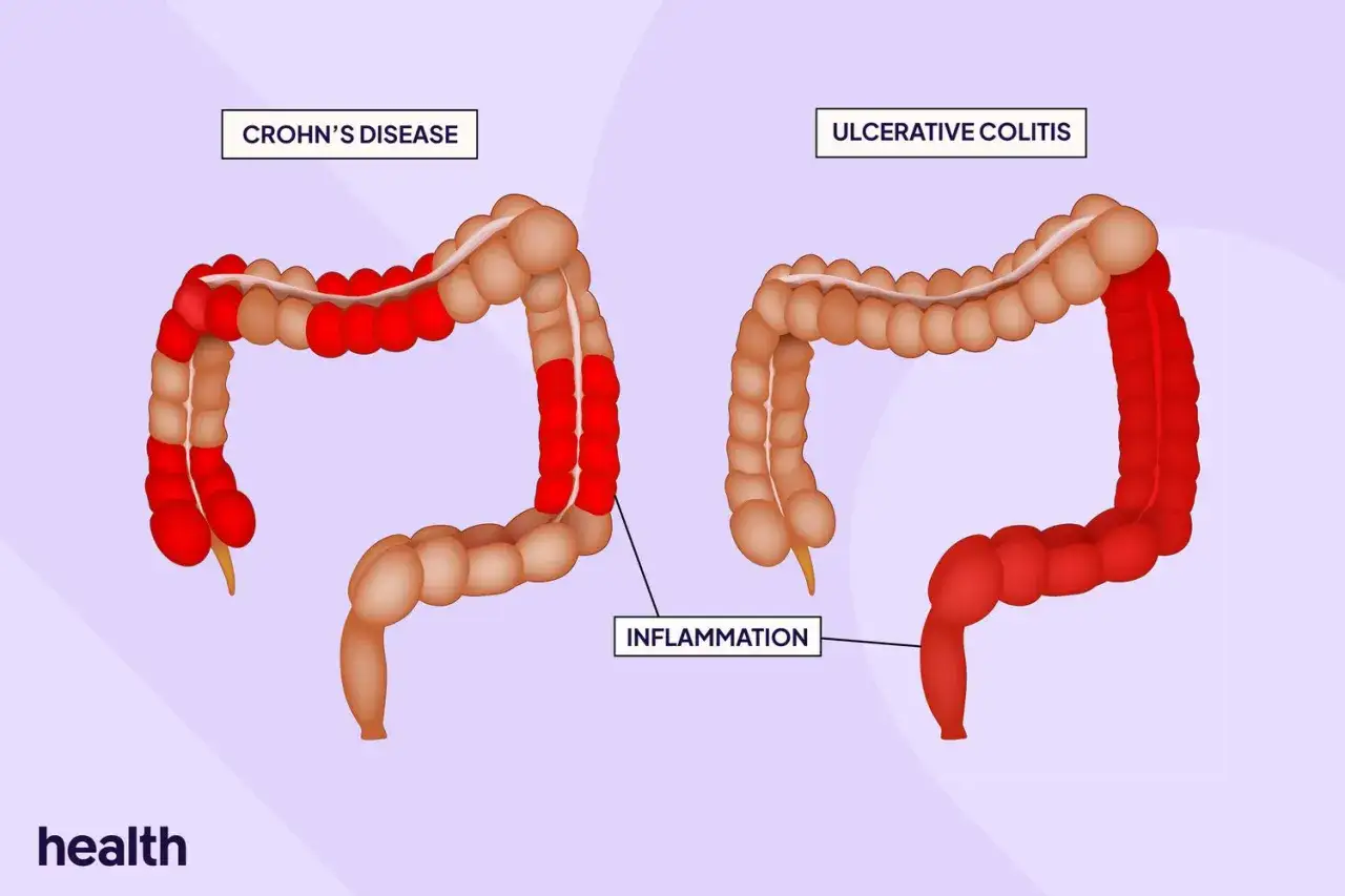 Vergleich von Morbus Crohn und Colitis ulcerosa: Entzündungen im Darm. Morbus Crohn zeigt diskontinuierliche Entzündungsherde, Colitis ulcerosa eine durchgehende Entzündung.