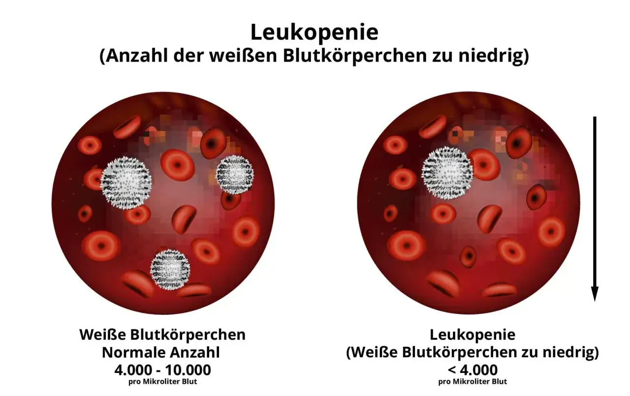 Vergleich von Blutbildern: Links normale Anzahl wei&szlig;er Blutk&ouml;rperchen, rechts Leukopenie (leukozyten zu niedrig).