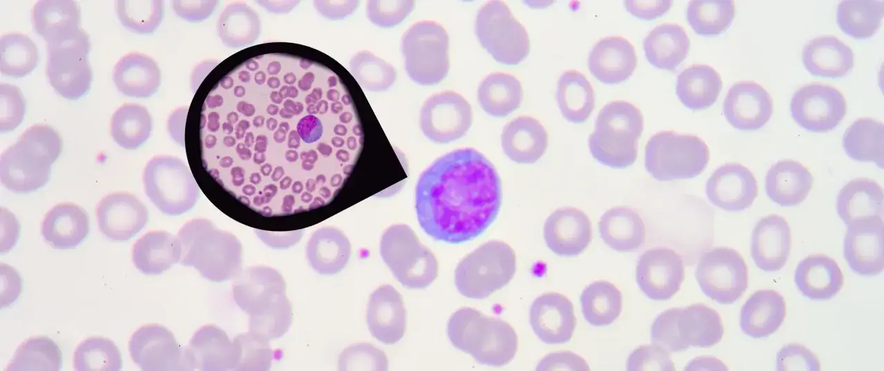 Mikroskopische Aufnahme von Blutzellen. Ein vergr&ouml;&szlig;erter Lymphozyt deutet auf zu hohe Lymphozyten hin.