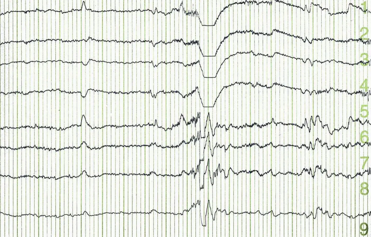 EEG-Aufzeichnung zeigt einen Krampfanfall, aber keine typischen epileptischen Muster. Die Wellen sind unregelmäßig und zeigen eine plötzliche Aktivität.