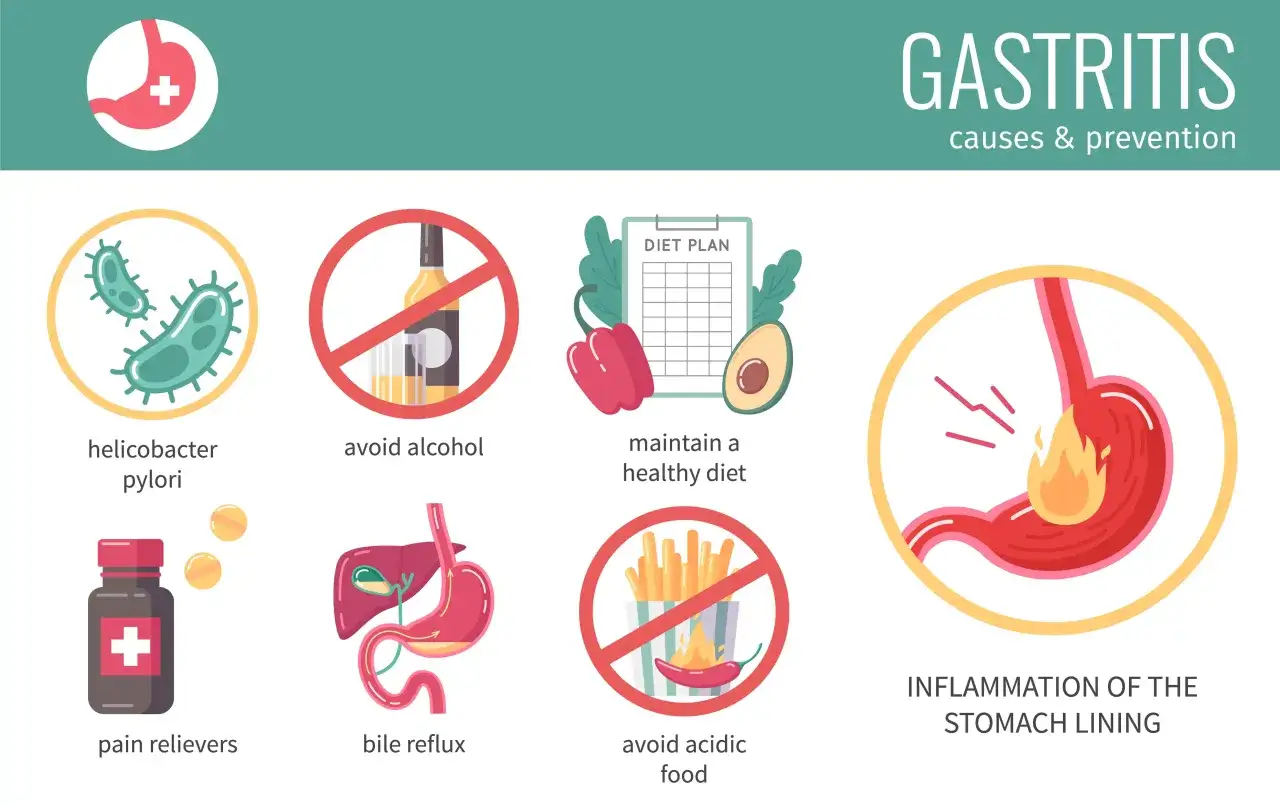 Gastritis-Ursachen: Helicobacter pylori, Alkohol, ungesunde Ern&auml;hrung, Schmerzmittel, Gallereflux. Entz&uuml;ndung der Magenschleimhaut. Gastritis wird nicht besser trotz Pantoprazol?