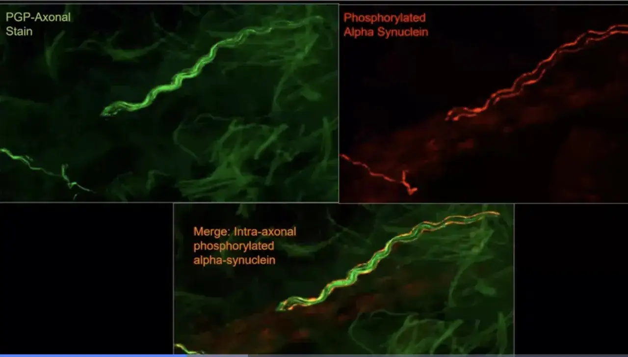 Mikroskopische Aufnahme von Nervenfasern, die f&uuml;r Parkinson-Tests relevant sind. Gr&uuml;n zeigt Axone, Rot phosphoryliertes Alpha-Synuklein.