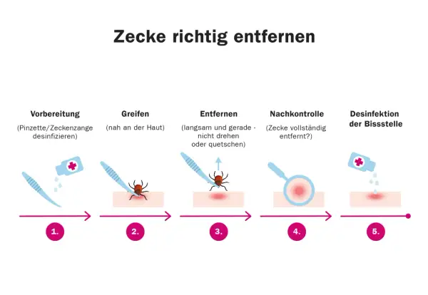 Schritt-für-Schritt-Anleitung zur zecke entfernen: Vorbereitung, Greifen, Entfernen, Nachkontrolle und Desinfektion der Bissstelle.