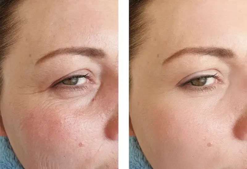 Vorher-Nachher-Vergleich zeigt die beeindruckende **Retinol Wirkung** auf die Haut. Falten sind sichtbar reduziert, die Haut wirkt glatter und jugendlicher.